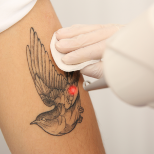 Eliminación de Tatuaje