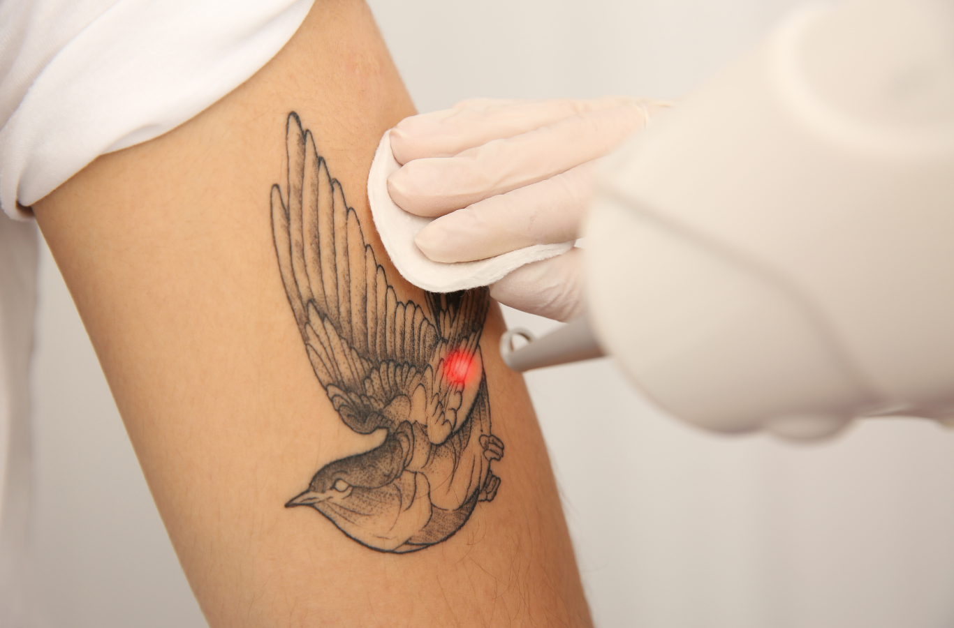Eliminación de Tatuaje